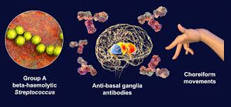 Image result for Chorea