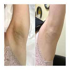 A quick but thorough tutorial on bleaching the knots of a brazilian body wave closure. Skin Bleaching Anal Bleaching Vaginal Bleaching Las Vegas