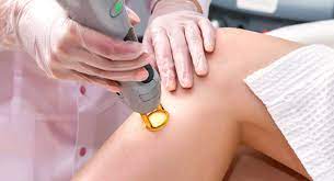 Laser Hair Removal for Teens: Is It Right for You?