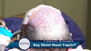 Sac Ekimi Nedir Ve Nasil Yapilir Neopital Health Aesthetic