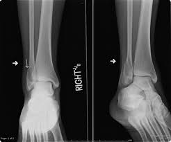 A maisonneuve fracture, for example, involves a complete disruption of the ligaments around the ankle associated with a fracture of the fibula at the level of the knee. Ankle Fractures Trauma Orthobullets