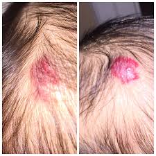 They typically start to occur around age 30 and often increase in size and number as we age. 9 Strawberry Hemangioma Ideas Pediatrician 2 Month Olds Strawberry