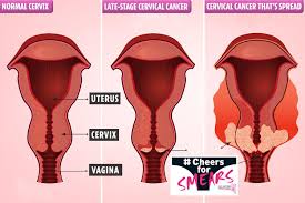 Know the signs and symptoms. The 5 Early Signs You Could Have Silent Killer Cervical Cancer After Millions Skip Smear Tests
