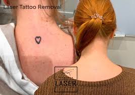 Mother who lost eight stone. Laser Tattoo Removal In Plymouth Whiteroom Laser Ltd