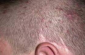 Common scalp conditions such as acne and dermatitis can cause folliculitis. Folliculitis Can Cause Hair Loss Body4real