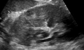 Image result for Perinephric Abscess