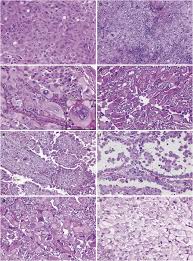 Malignant pleural mesothelioma with osteoblastic heterologous elements. Deciduoid Mesothelioma Report Of 21 Cases With Review Of The Literature Modern Pathology