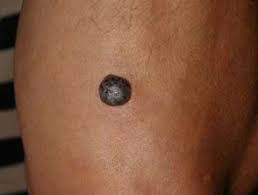 It is known that some environmental factors can give rise to this condition and exposure to certain chemicals causes their formation. Cherry Angioma Dermnet Nz