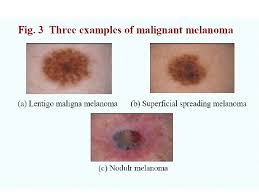 The american academy of dermatology advises that you watch skin spots for these features: Melanoma And Skin Cancers Vs Image Processing Skin