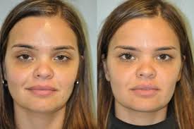 It is entirely normal to experience a slight bit of bleeding at the. Facial Fillers Before And After Photo Gallery Palo Alto San Jose California L P Aesthetics