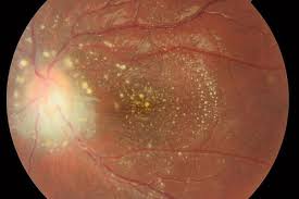 Image result for Uveitis