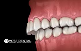 What you need to know about transforming your smile with invisalign® treatment. Fix Overbite Using Invisalign Voss Dental Oral Surgery Implant