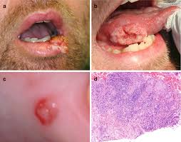 Image result for spinocellular carcinoma of the oral cavity
