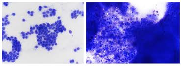 One tumor incompletely excised from the dermis, identified histologically w/o regional ln involvement a. Color Cytology Atlas Of Common Feline Skin Tumors Mspca Angell