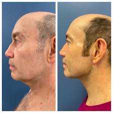 🌟 5-Star Review from One of Our 5-Star Patients! 🌟 We're thrilled to  share the success story of this incredible 60-year-old gentleman who  underwent a neck lift and liposuction to his abdomen