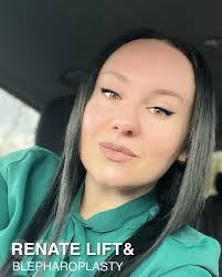 Renate Lift and rhinoplasty .✨ For detailed information; ☎ +90 538 659 60  00 📧 info@renateclinic.com 📍Istanbul