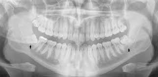 These teeth break through later on in life, and can cause discomfort during their eruption phase. Removal Of Impacted Wisdom Teeth British Association Of Oral And Maxillofacial Surgeons