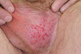 Extramammary Paget S Disease Springerlink