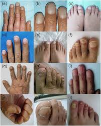 Image result for Clubbing nails feet