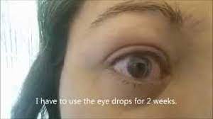 What happens if you sleep with contacts on. What Happens If You Sleep With Contacts On Youtube
