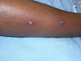 The symptoms of a pilonidal cyst include: Skin And Soft Tissue Infections Knowledge Amboss