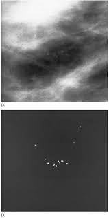 Elle n'est pourtant pas obligatoire. An Example Of A Cluster Of Malignant Microcalcifications In The Data Download Scientific Diagram