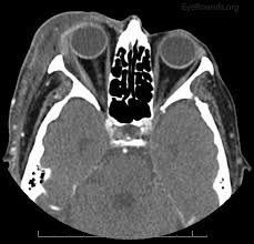 Program within @mayoclinicgradschool is currently accepting applications! Periorbital Necrotizing Fasciitis
