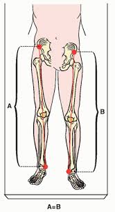 Image result for Functional Leg Length Discrepancy