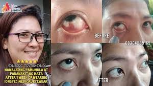 IONSPEC TESTIMONY A Positive feedback of Maam Liza Lula Castro. Pinahiram  lang sya ng kapatid nya ng Ionspec M38b Violet dahil namumula at masakit  ang mata nya, after 1 week of