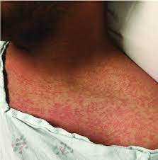They usually result from skin inflammation, which can have many causes. Typical Maculopapular Rash Of Zika Virus Photograph Courtesy Of Dr Download Scientific Diagram