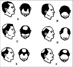 These symptoms of baldness are associated with the male sex androgens. Koo S Classification Of Male Pattern Baldness A M Type B C Type Download Scientific Diagram
