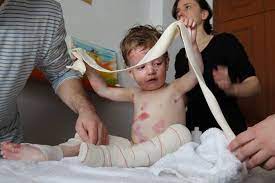 Mas De La Mitad De Los Afectados Con Piel De Mariposa Facebook