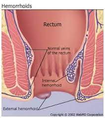 Maybe you would like to learn more about one of these? Hemorrhoids Internal External Pictures Symptoms Causes Treatment