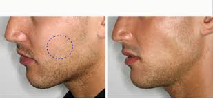 Famosas con cara redonda se han sometido a este procedimiento. Luzca Un Rostro Mas Delgado Y Estilizado Separa Con 100 Bichectomia Cirugia Para La Definicion Del Rostro Ofertadeldia
