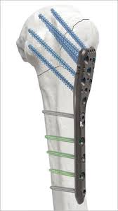 Humerus compression plate - AOS - Advanced Orthopaedic ...