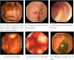 Image result for Small Intestinal Bleeding