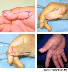fingertip utations finger flaps