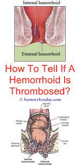 Could Hemorrhoids Be A Sign Of Colon Cancer Bleeding Hemorrhoids Hemorrhoids Treatment Hemorrhoids