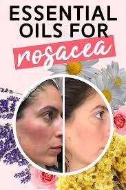 essential oils for rosacea my story