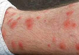 While nail polish isn't a good treatment for chigger bites, anything that can help control the itchingcan be helpful, including: How To Get Rid Of Chigger Bites Video