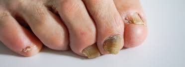 Image result for onychomycosis