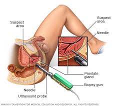 Prostate cancer is one of the most common types of cancer diagnosed in men. Prostate Cancer Diagnosis And Treatment Mayo Clinic