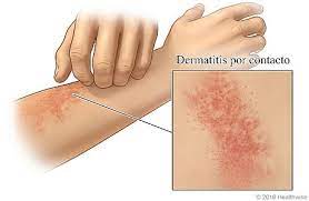 Dermatitis Por Contacto Cigna