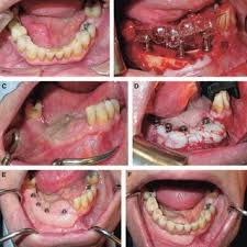 But not all cells are the same if you think you might be experiencing symptoms, set up an appointment with your dental professional immediately. Pdf Oral Rehabilitation Following Treatment For Oral Cancer