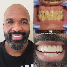 Stained or crooked teeth aren't a problem if you know what your options  are. The BEST option you can choose is our cosmetic BilVeneer, hands down!  Just look at his results! #cosmeticveneer #