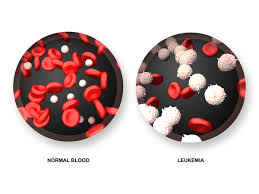 Men experiencing urinary symptoms need further investigation, possibly including blood tests and a. Chronic Myeloid Leukemia Medlineplus Genetics