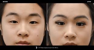 Asian brow lift before and after. Asian Eyelid Surgery 77p Gallery 77p Gallery