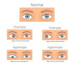 Wir wünschen dir und deiner familie alles liebe und viel erfolg. Schielen Strabismus Formen Therapie Aumedo