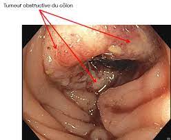 Tous stades confondus, la survie à 5 ans du cancer du côlon est d'environ 60 % 2. Cancer Du Colon Cancer Colorectal Snfge Org Societe Savante Medicale Francaise D Hepato Gastroenterologie Et D Oncologie Digestive