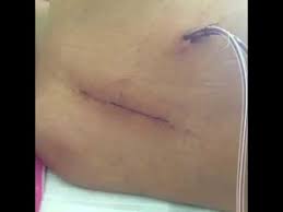 Titisan pernafasan yang mengandungi bakteria boleh berjangkit daripada seorang individu ke individu lain apabila dihirup. Tb Tulang Belakang Menggerogoti Dan Melumpuhkanku Namun Kini Aku Sembuh Youtube